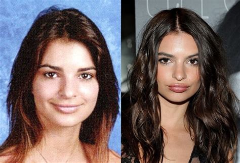 are emily ratajkowski lips fake